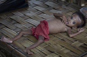 Myanmar Malnourished Rohingya